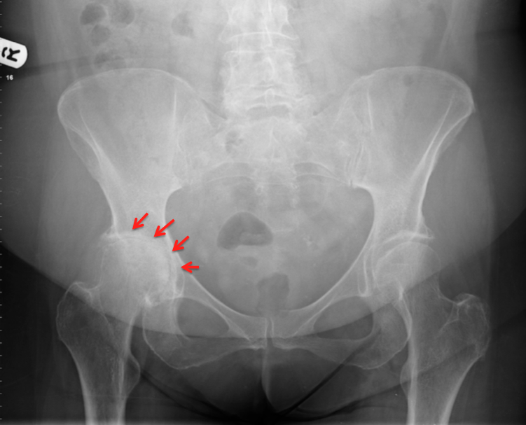 Hip arthritis